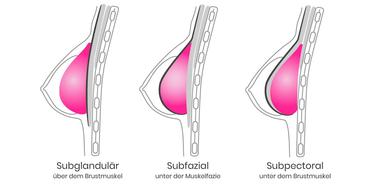 Grafik Implantatlage Brustvergrößerung