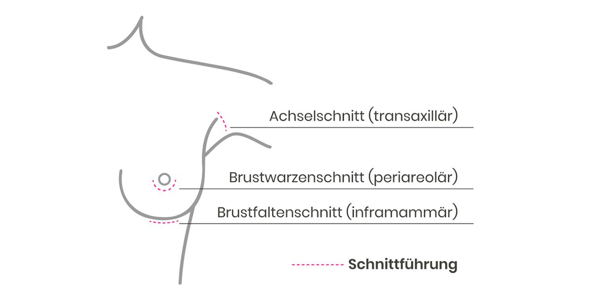 Grafik Schnittführung Brustverkleinerung